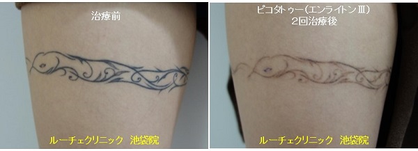 タトゥー除去ピコレーザー、6回、胸、黒