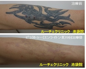 タトゥー除去ピコレーザー、5回、手首、黒