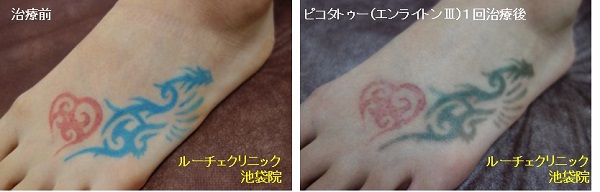 タトゥー除去ピコレーザー、1回、指、黒