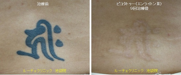 タトゥー除去ピコレーザー、5回、首、黒