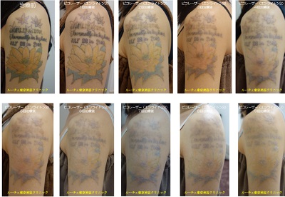 肩のカラータトゥーの経過連続写真です、経過
