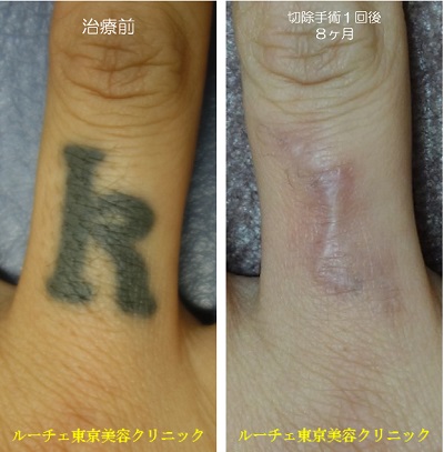 指のタトゥーを切除しました。