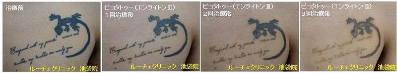 タトゥー除去ピコレーザー、5回、腕、黒