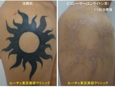 肩のベッタリと濃いタトゥーを薄くしています。＿
