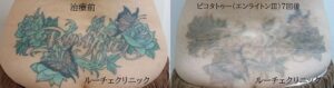 タトゥー除去ピコレーザー、7回、腰、緑、黒の症例写真ビフォーアフター