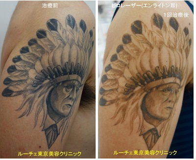 腕のタトゥーが１回のピコレーザーで薄くなりました＿
