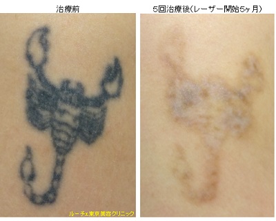 腕のサソリタトゥー