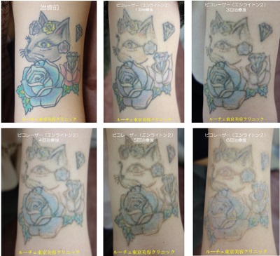 ６色カラフルマルチカラー黒ピンク水色青紫黄、６回治療の経過写真、経過