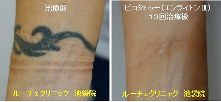 タトゥー除去ピコレーザー、13回、手首、黒、とれた