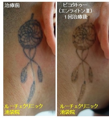 タトゥー除去ピコレーザー、2回、指、黒