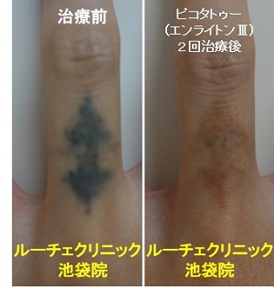 タトゥー除去ピコレーザー、4回、腕、黒