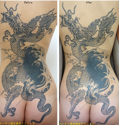 広い範囲のタトゥーでも１度の来院で可能な限り全範囲照射します。＿
