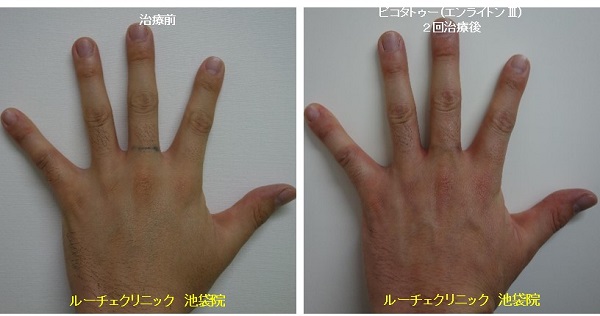 タトゥー除去ピコレーザー、12回、腕、黒