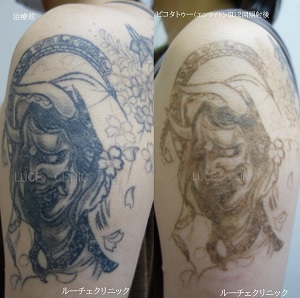 タトゥー除去、2回、腕、黒