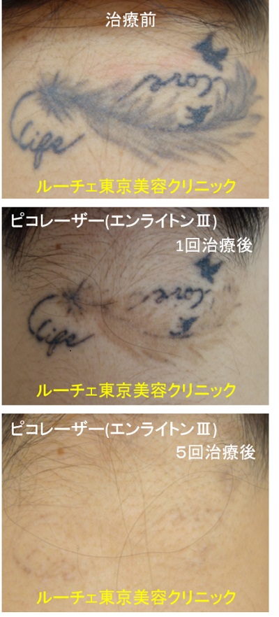 うなじの黒一色タトゥー、ピコレーザーの経過写真です＿