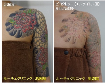 タトゥー除去ピコレーザー、7回、腕、黒