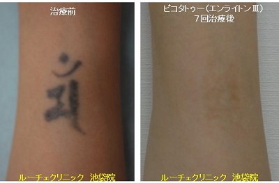 タトゥー除去ピコレーザー、1回、耳裏、黒、水色