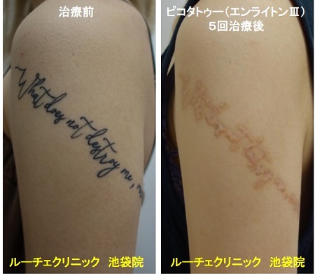 タトゥー除去ピコレーザー、1回、足の甲、黒