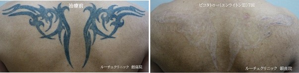 タトゥー除去ピコレーザー、背中、黒