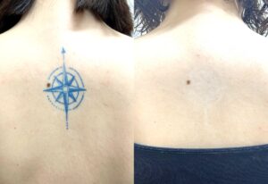 タトゥー除去 背中 青