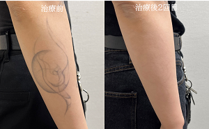 タトゥー除去ピコレーザー、右肘下のタトゥー、黒、2回