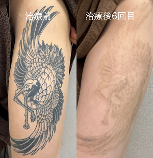 タトゥー除去ピコレーザー　太もものタトゥー、黒、６回