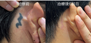 タトゥー除去ピコレーザー、耳裏のタトゥー、黒、６回