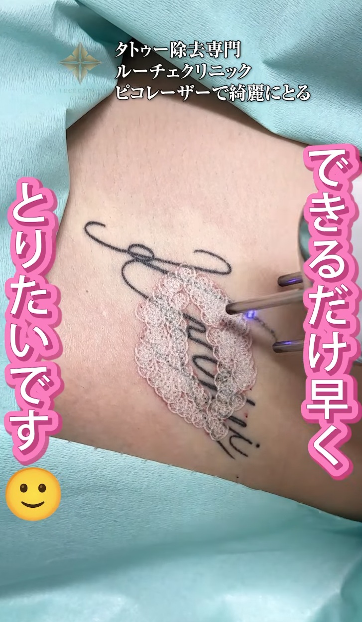 タトゥー除去症例動画