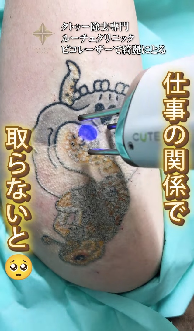 タトゥー除去症例動画