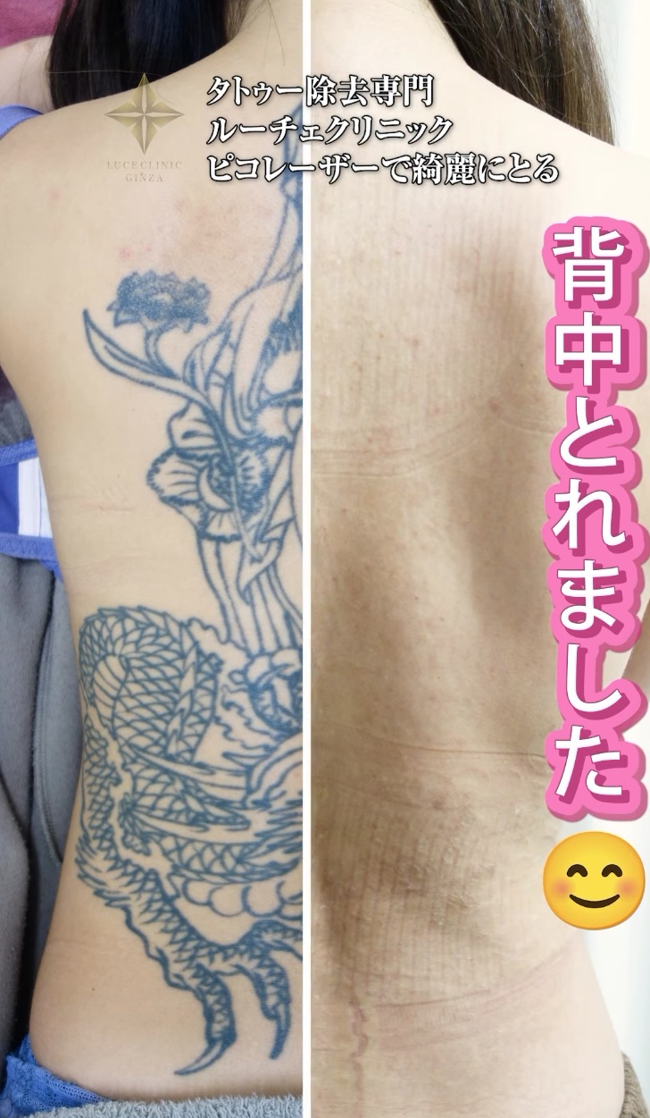 タトゥー除去症例動画