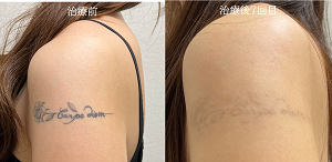 タトゥー除去ピコレーザー、腕のタトゥー、黒、７回、結婚式までにできるだけ綺麗にしたい